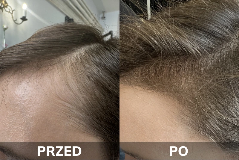 Porównanie efektów przed i po kuracji na porost włosów: po lewej stronie widoczne przerzedzone włosy przy linii czoła z podpisem „PRZED”, po prawej stronie zagęszczone włosy w tym samym miejscu z podpisem „PO”.